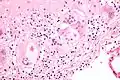 Micrograph of asteroid bodies in pulmonary sarcoidosis. H&E stain.