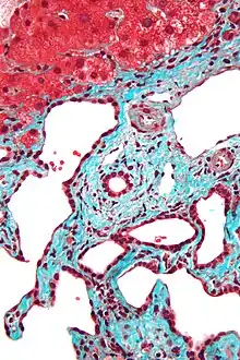 Micrograph of a bile duct hamartoma. Trichrome stain, high magnification