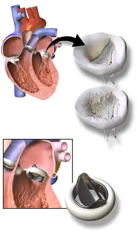 3D Rendering of Mechanical Valve (St. Francis model)