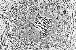 Light micrograph of undecalcified tissue displaying osteoblasts actively synthesizing rudimentary bone tissue (center).