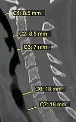 CT scan with upper limits of the thickness of the prevertebral space at different levels.