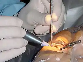  close-up photo showing the hands of a surgeon holding phaco instruments inserted into the patient's eye. The eyelids are held apart by a speculum.