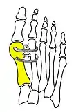 Cerclage bone sutures