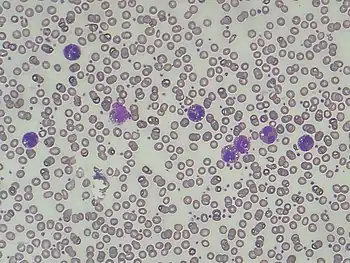 Jordans' anomaly in Chanarin-Dorfman syndrome