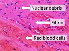 Composition of a fresh thrombus at microscopy, showing nuclear debris in a background of fibrin and red blood cells.