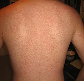 Cross reaction rash