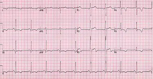 ECG showing HOCM