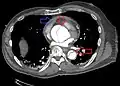 Type A dissection with pericardial effusion as a result.