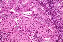 Image of the histology of an endometrioid endometrial adenocarcinoma