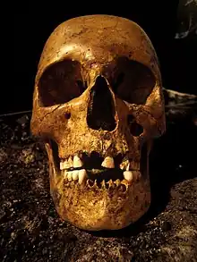 A skull with a hole below the left eye socket