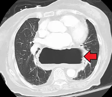 A large hiatal hernia as seen on CT imaging