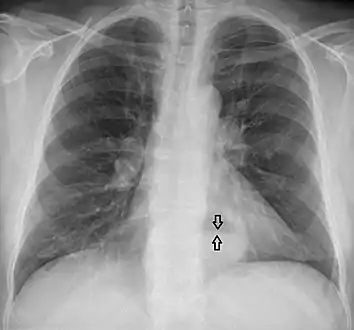 This hiatal hernia is mainly identified by an air-fluid level (labeled with arrows).