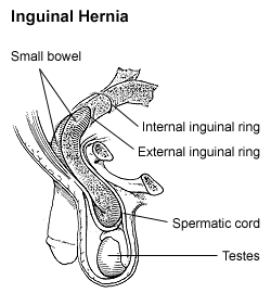 Diagram of an indirect, scrotal inguinal hernia (median view from the left)