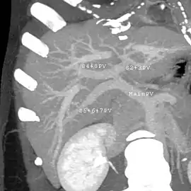 MDCT image. Portal venous anatomy contraindicated for liver donation