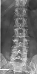 Lumbarization of sacral vertebra 1, seen as 6 vertebrae that do not connect to ribs.