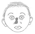 Nasal dysplasia