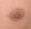 C – Chest hair around nipple of adolescent male.