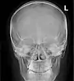 Paranasal sinuses radiograph (occipitofrontal)