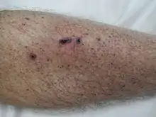 Petechia of the lower leg in a person with platelets of 3 due to ITP