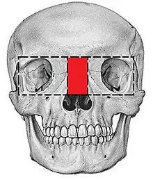 Box Osteotomy