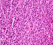 Plasmacytoma, H&E stain