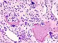 Histopathology of osteoarthrosis of a knee joint in an elderly female