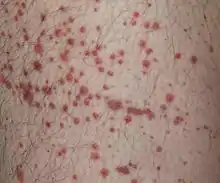 Red, non-blanching skin lesions on the upper leg