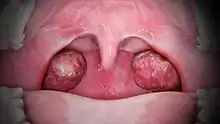 A medical animation still that shows Tonsillitis.