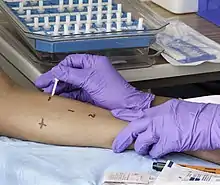 Skin prick testing allergies