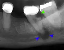 Decay (green) with apical abscess (blue)