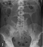 An x-ray of a person with a small bowel volvulus.